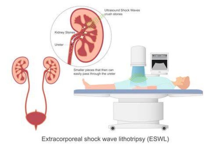 Are you awake for lithotripsy